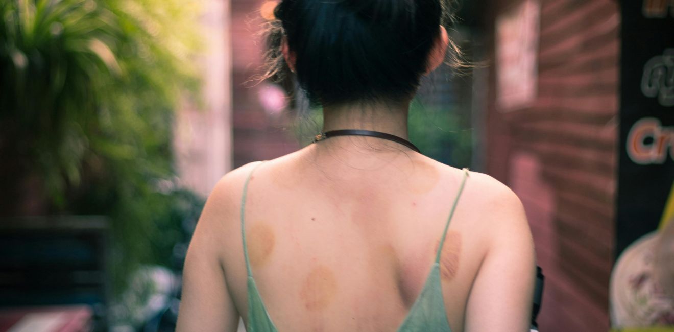 Pode tomar sol com marca de ventosa? 